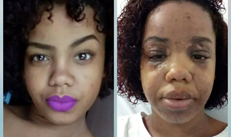 PANELA DE PRESSÃO QUASE MATA MULHER!!!! (FOTOS)