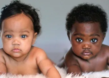 Gêmeas com cores de pele diferentes agitam as redes sociais