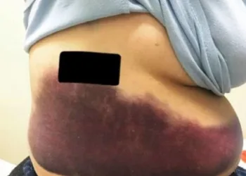 MULHER QUEBRA A COSTELA APÓS CRISE DE TOSSE!!!