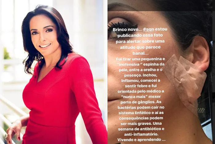 APRESENTADORA DA GLOBO EXPREME ESPINHA E SE DA MAL….