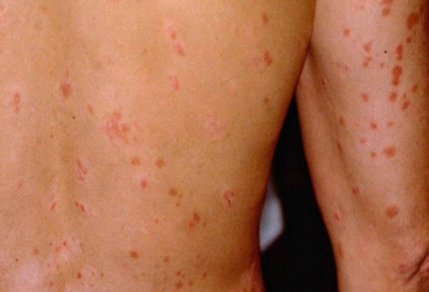 ihhhhhhhhh!!! Ator revela que pegou sarna ao usar figurino sujo da Record