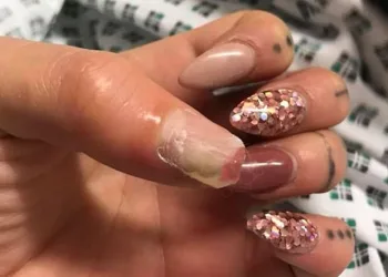 Mulher pode perder dedo da mão após usar unha de acrílico(imagem forte)