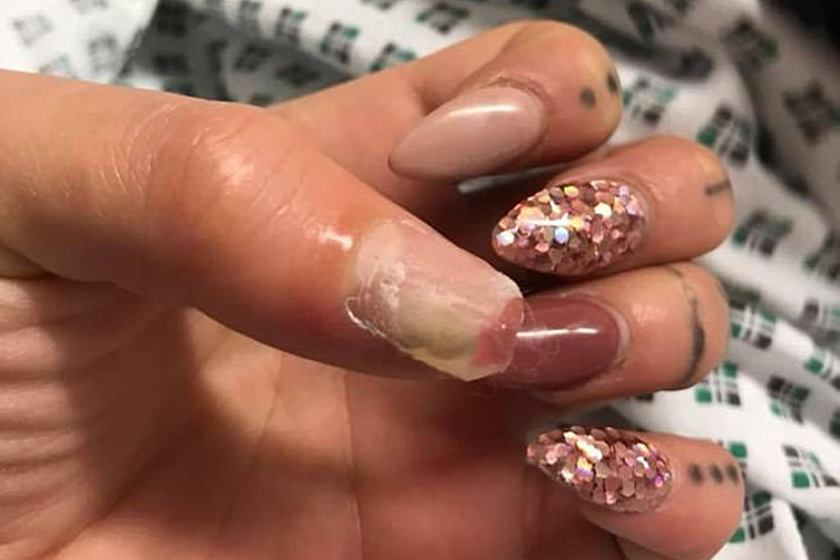 Mulher pode perder dedo da mão após usar unha de acrílico(imagem forte)