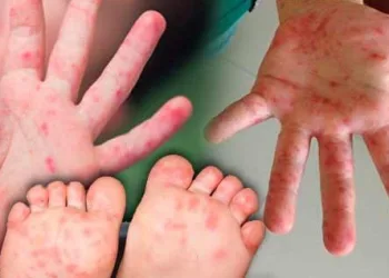 Doença mão-pé-boca está se espalhando em creches e escolas. Os pais devem estar atentos aos sintomas e medidas preventivas!!!