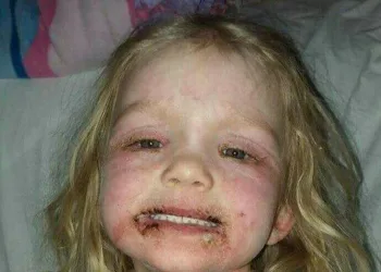 Menina tem reação alérgica após usar maquiagem de má qualidade