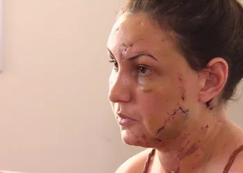 Estudante relata como foi espancada por namorado que se matou em motel