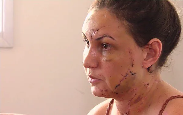 Estudante relata como foi espancada por namorado que se matou em motel