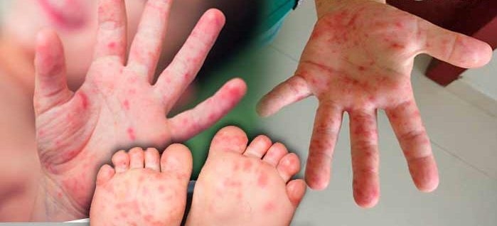 SEU FILHO ESTÁ COM ESSA DOENÇA? MÃO-PÉ -BOCA COM ESSAS BOLINHAS? ISSO PODE AJUDAR…