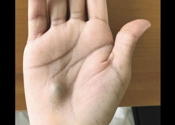 Este simples caroço em sua mão era um sinal de que sua vida estava em grave risco. Entenda!