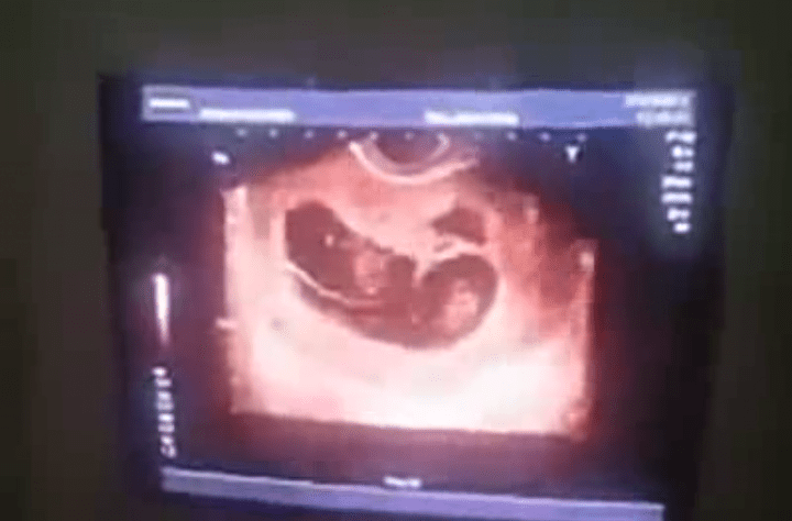 Grávida de 9 Semanas Engravida Novamente!!!