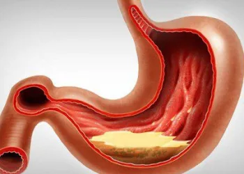 Mude 12 hábitos para prevenir a azia