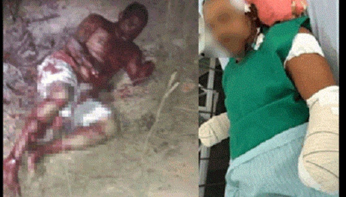 Estuprador de bebê de apenas 7 meses tem as duas mãos decepadas pelo pai da vítima