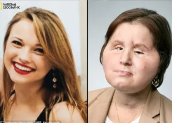 Mulher é a mais jovem a receber transplante de rosto