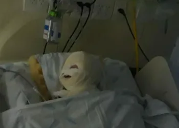 Aparelho explode durante cirurgia e bebê de 1 ano tem rosto queimado