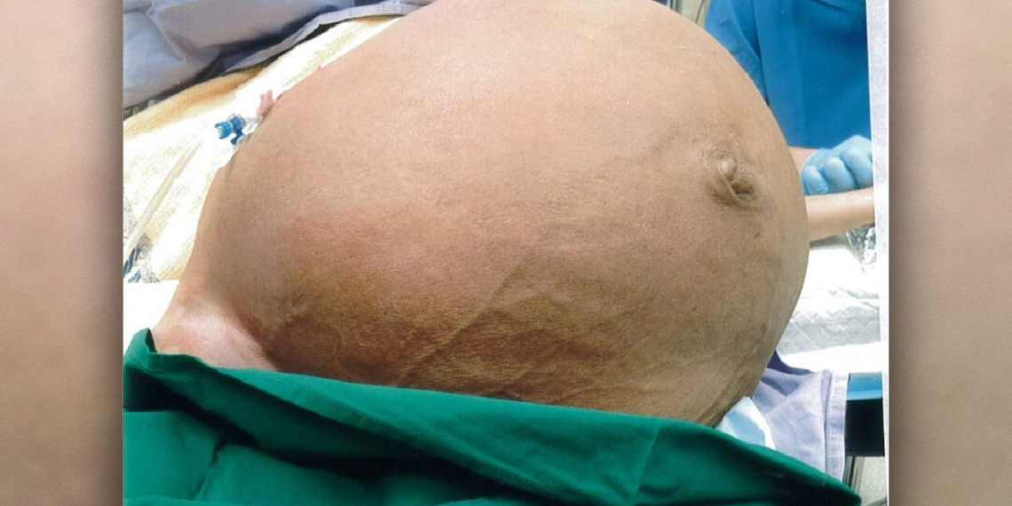 Mulher fica sem respirar por causa de tumor enorme de 27 kg na barriga