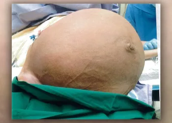Mulher fica sem respirar por causa de tumor enorme de 27 kg na barriga