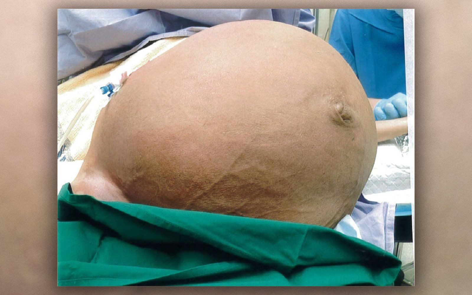 Mulher fica sem respirar por causa de tumor enorme de 27 kg na barriga