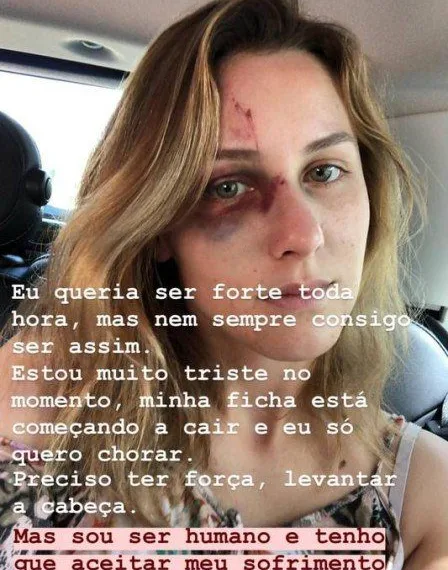 Brasileira agredida pelo namorado nos EUA faz alerta sobre relacionamento abusivo