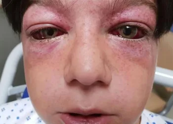 Novo desafio da internet deixa criança de 11 anos gravemente ferida