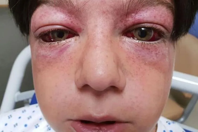 Novo desafio da internet deixa criança de 11 anos gravemente ferida