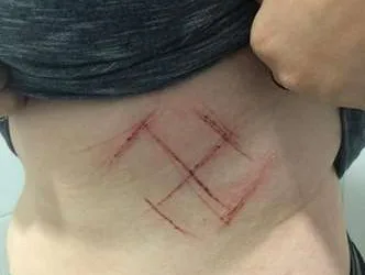 Marca de suástica em jovem  foi automutilação, aponta laudo