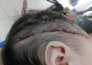 Recém-nascida é cortada com bisturi durante parto e leva 25 pontos