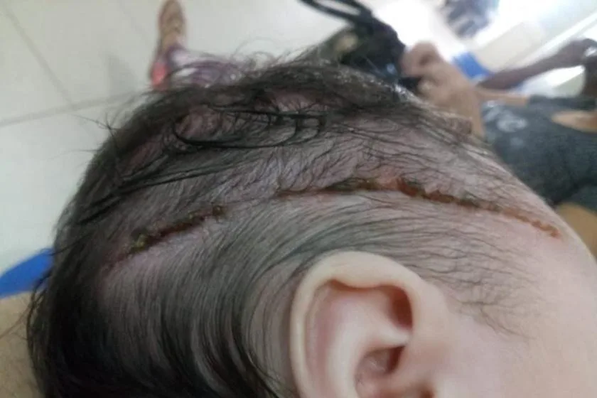 Recém-nascida é cortada com bisturi durante parto e leva 25 pontos