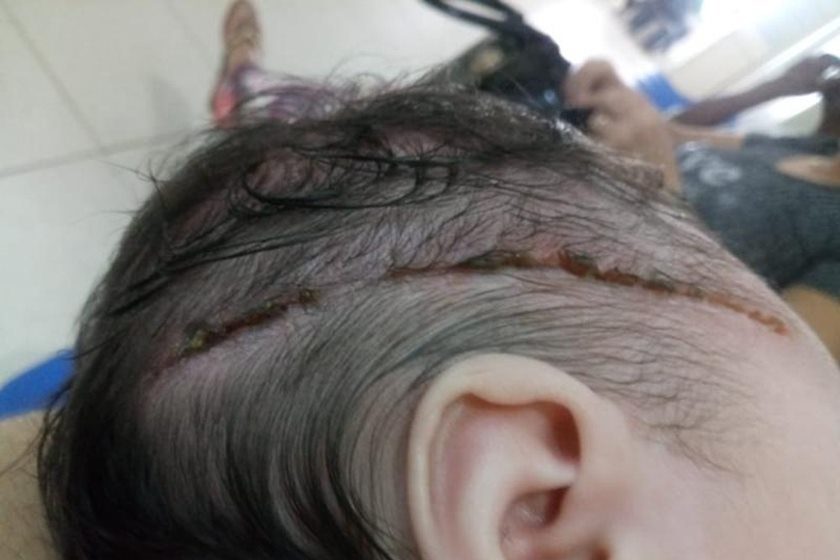 Recém-nascida é cortada com bisturi durante parto e leva 25 pontos