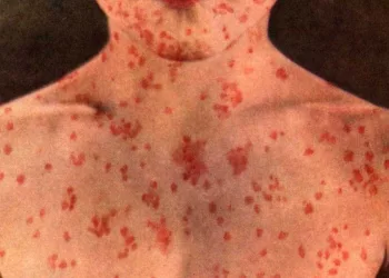 Sarampo: saiba o que é, prevenção, sintomas e tratamento