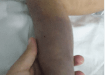 Bebê pode perder a perna por negligência médica no RJ!!