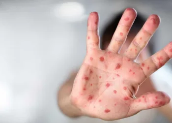 Com 12 mortes confirmadas, casos de sarampo ultrapassam 10 mil no país