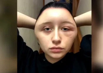Jovem fica em estado grave após reação alérgica a tinta de cabelo