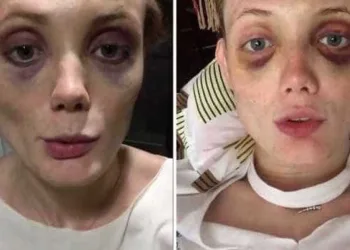 Top Model mostra hematomas e denuncia agressões de ex-namorado na Web