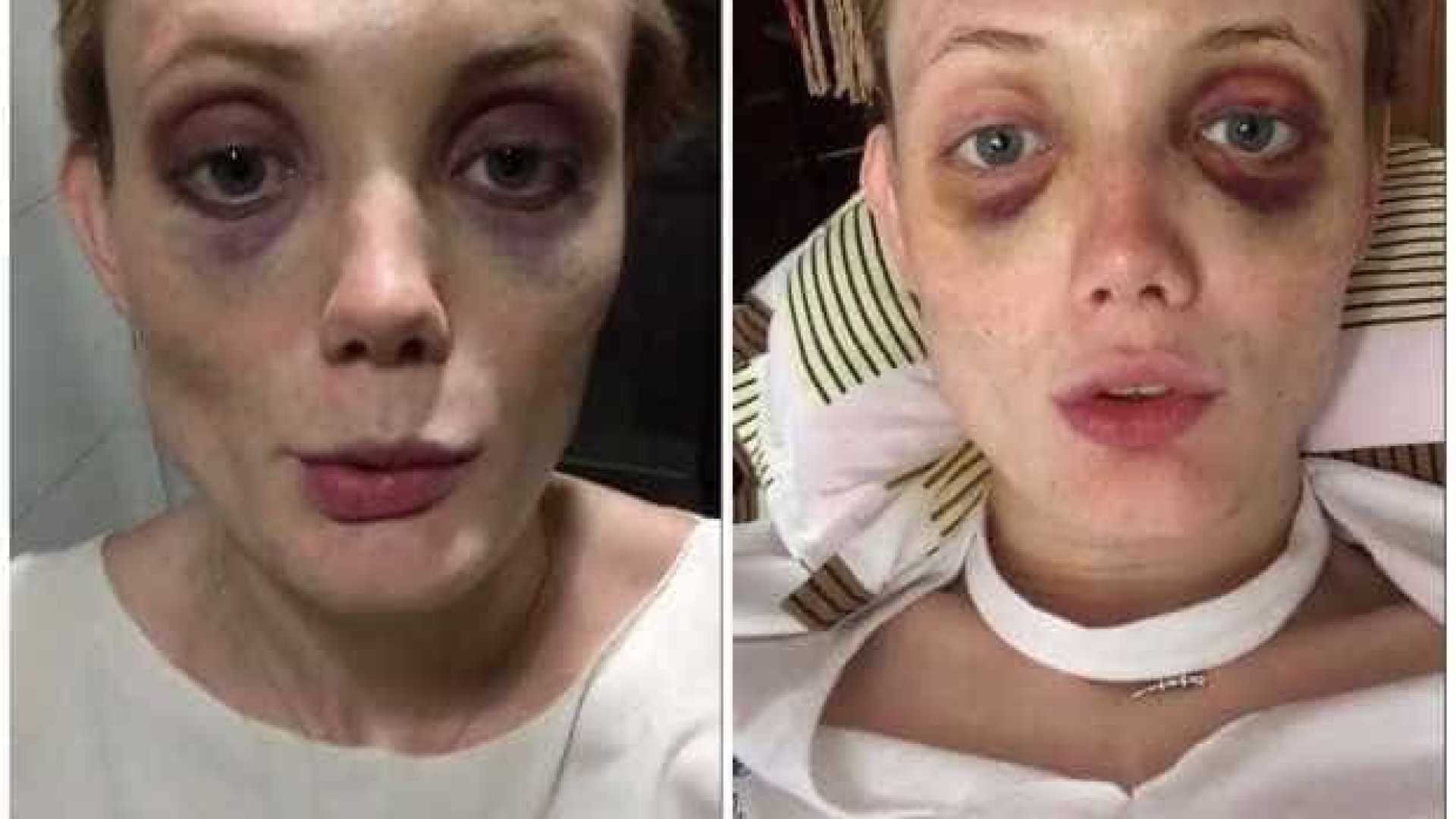 Top Model mostra hematomas e denuncia agressões de ex-namorado na Web