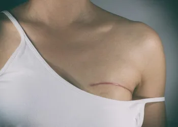 Lei garante cirurgia reconstrutiva da mama para mulheres com câncer