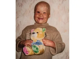 Após 13 anos da tragédia, veja como está o menino que foi jogado em forno à lenha pelo pai