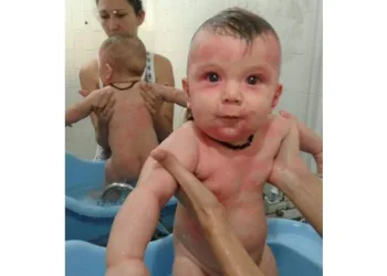 Mãe compartilha foto de alergia grave do filho e faz alerta