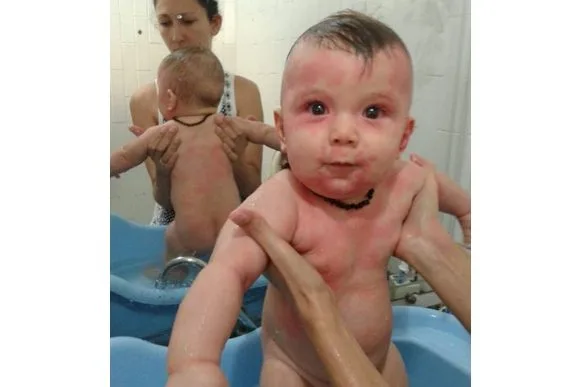 Mãe compartilha foto de alergia grave do filho e faz alerta