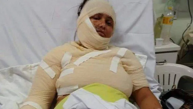 Homem deixa mulher com 70% do corpo queimado por não aceitar separação