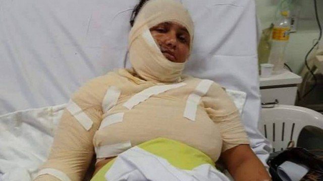 Homem deixa mulher com 70% do corpo queimado por não aceitar separação