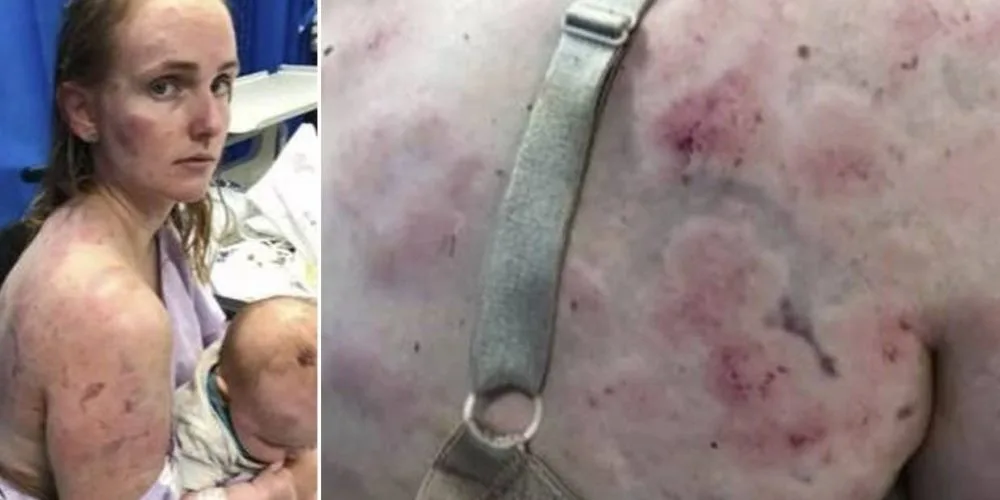 Mãe vira escudo humano para proteger bebê de tempestade de granizo