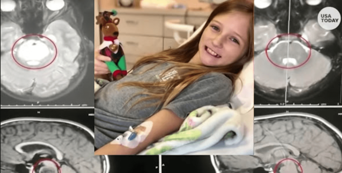 câncer inoperável no cérebro de menina desaparece