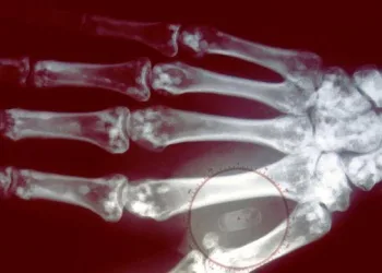 Como funcionam os microchips implantados sob a pele que permitem pagar sem dinheiro ou cartão