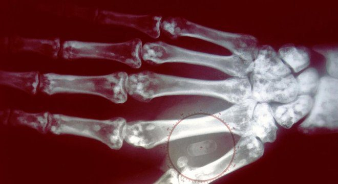Como funcionam os microchips implantados sob a pele que permitem pagar sem dinheiro ou cartão