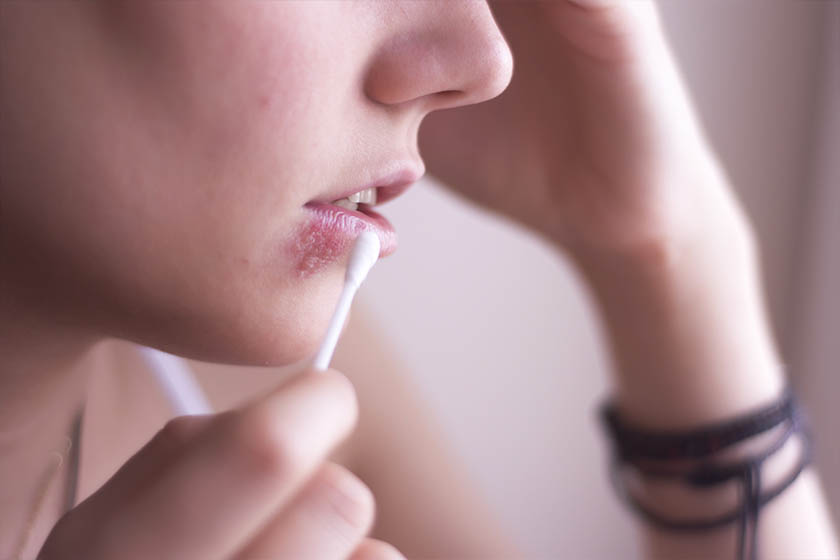 Herpes: conheça os tipos mais comuns do vírus e saiba como preveni-los