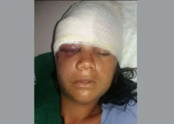 Jovem tem ossos do rosto quebrados a golpes de pá pelo ex-namorado na Costa Verde