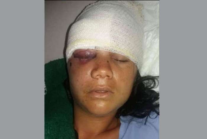 Jovem tem ossos do rosto quebrados a golpes de pá pelo ex-namorado na Costa Verde