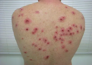 Sífilis está de volta com grande impacto no verão, agora na versão Epidemia