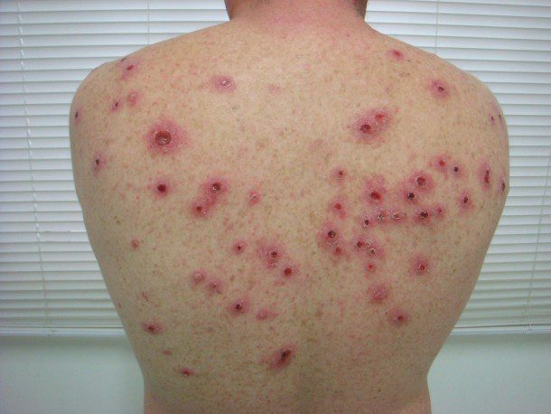 Sífilis está de volta com grande impacto no verão, agora na versão Epidemia