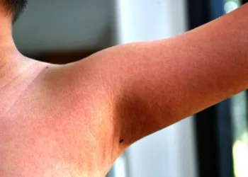 NOVO SURTO DE ESCARLATINA, UMA DOENÇA PERIGOSA QUE ATACA NOSSOS FILHOS: CONHEÇA OS SINTOMAS.